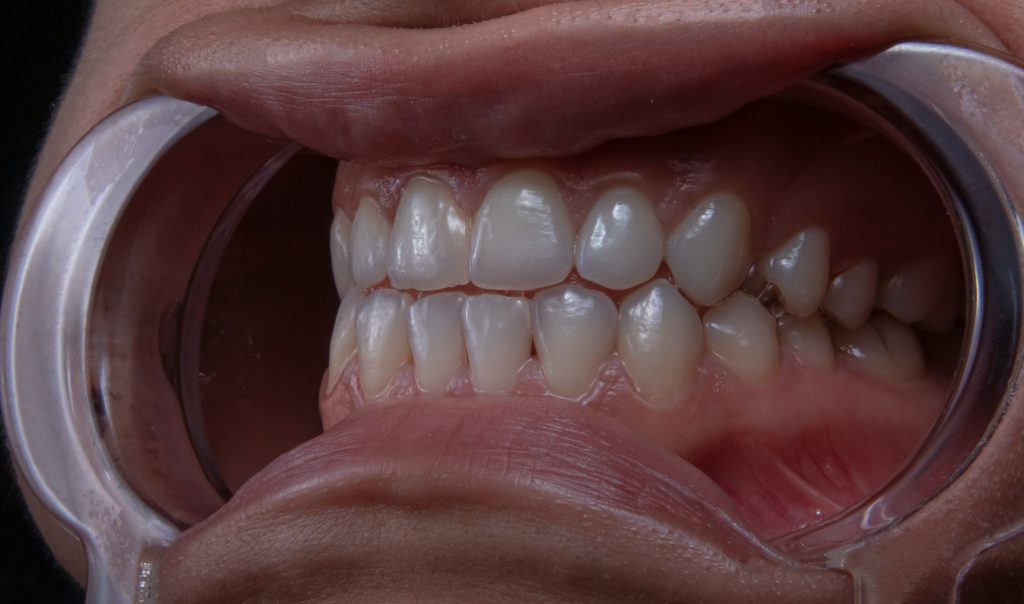 Which professional should be consulted to treat bruxism?
