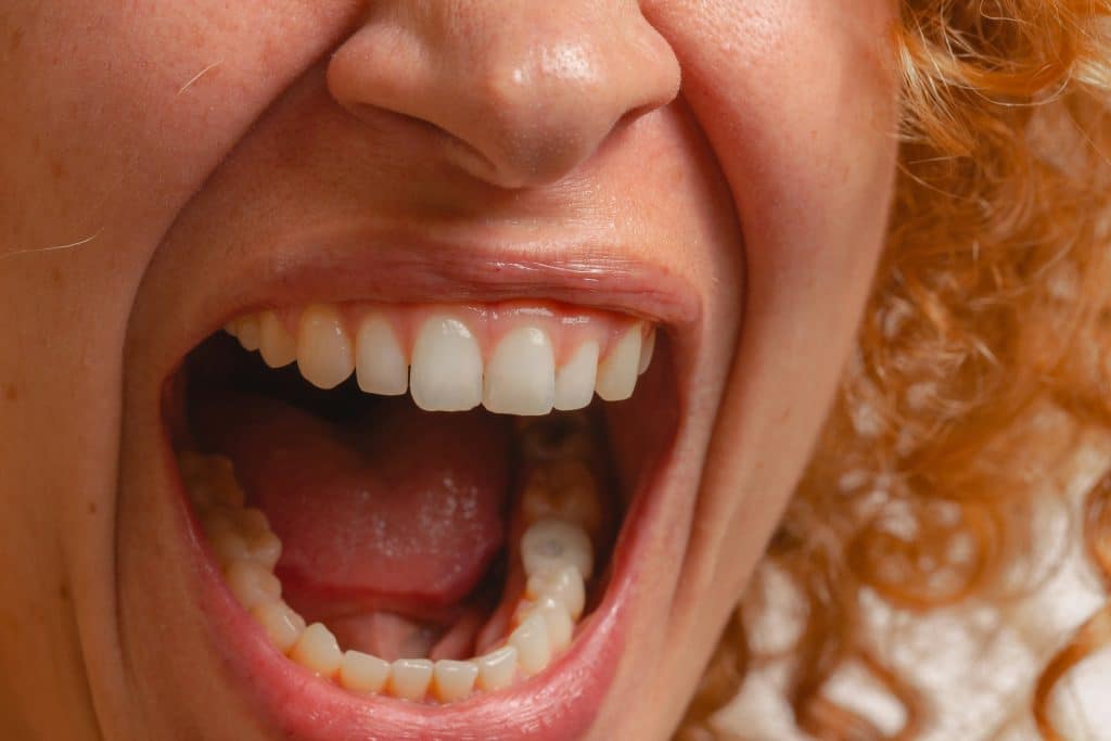 Mouth opening: understanding, measuring and improving jaw amplitude